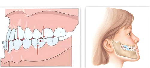 Niềng răng cho trẻ em 7 1 3